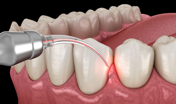 gum-treatment-kharadi